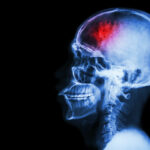 Film x-ray skull of head injury after an accident