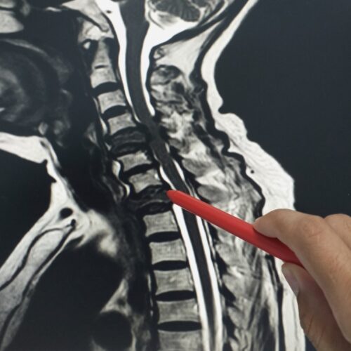 Personal injury attorney reviewing spinal cord injury MRI